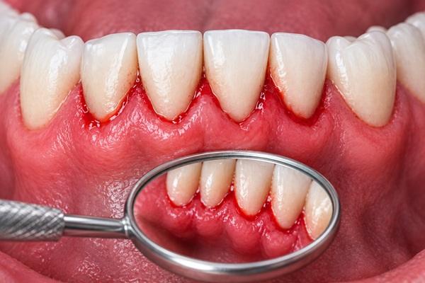 خونریزی لثه چگونه درمان میشود؟